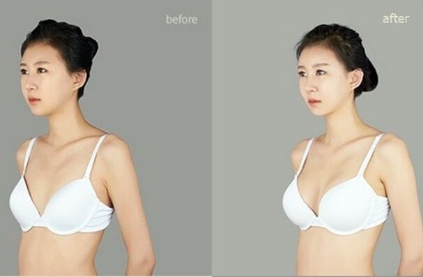 prieš ir po plastinio krūtų didinimo