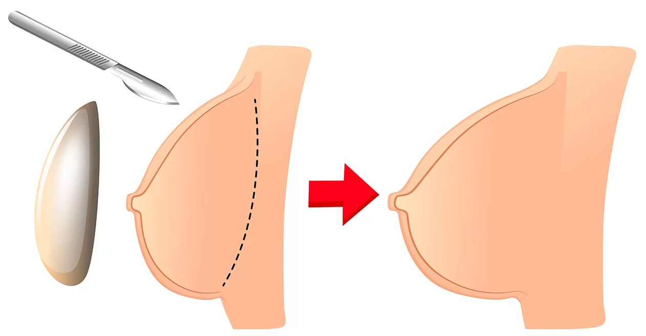 Krūtų didinimas implantu