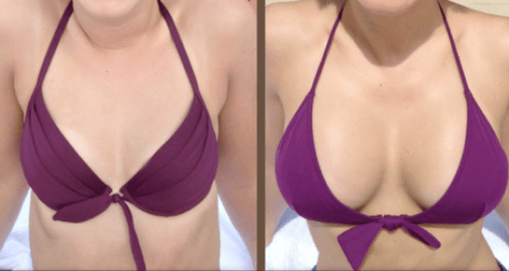 Prieš ir po krūtų didinimo operacijos