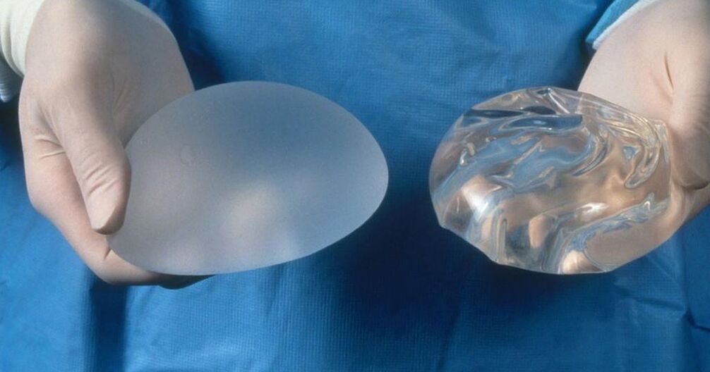 implantas