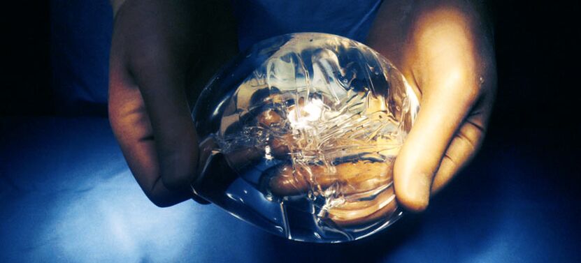 Silikono endoprotezas